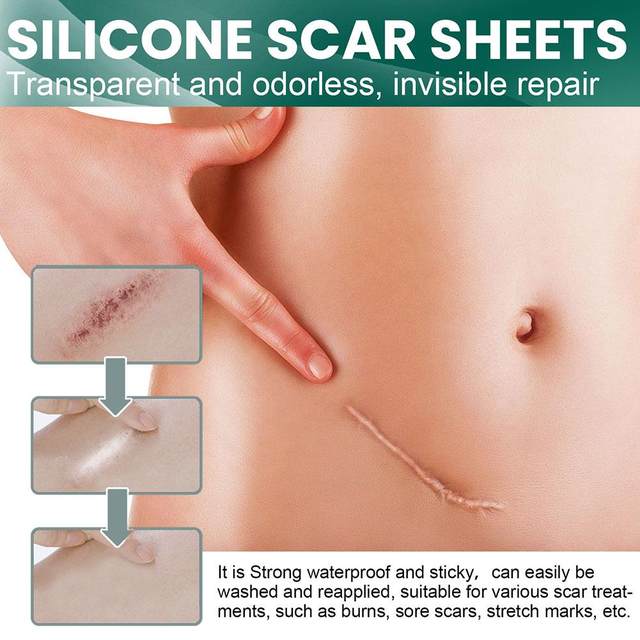 Silicone Scar Tape Roll – Surgical, C - Section, Keloid, Tummy Tuck Scar Removal - O'Homely