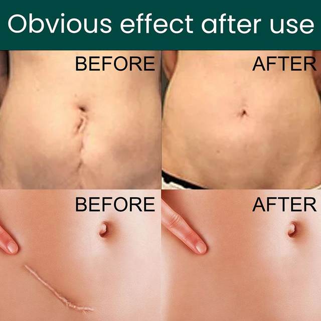Silicone Scar Tape Roll – Surgical, C - Section, Keloid, Tummy Tuck Scar Removal - O'Homely