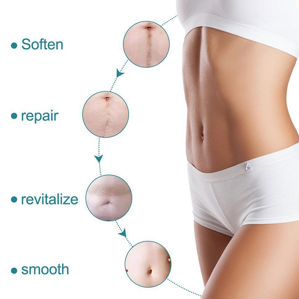Silicone Scar Tape Roll – Surgical, C - Section, Keloid, Tummy Tuck Scar Removal - O'Homely