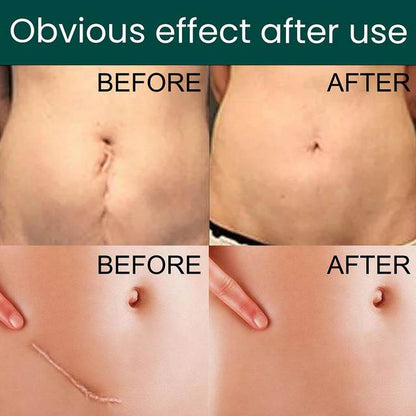 Silicone Scar Tape Roll – Surgical, C - Section, Keloid, Tummy Tuck Scar Removal - O'Homely
