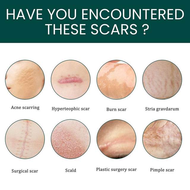 Silicone Scar Tape Roll – Surgical, C - Section, Keloid, Tummy Tuck Scar Removal - O'Homely